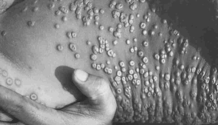 l'épidémie de la variole de singe détecté chez un couple