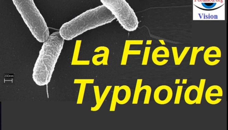 fièvre typhoïde