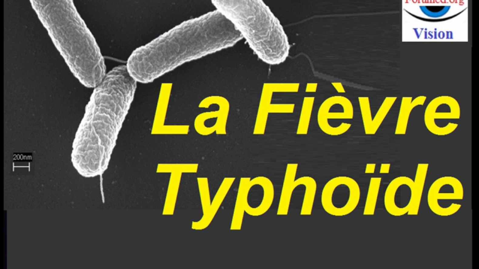 fièvre typhoïde
